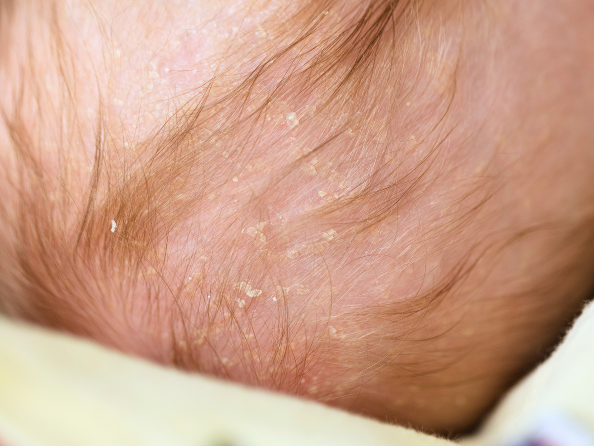 Understanding Delicate Scalp Barriers: A Gentle Guide for Babies (and Extra-Sensitive Adults)
