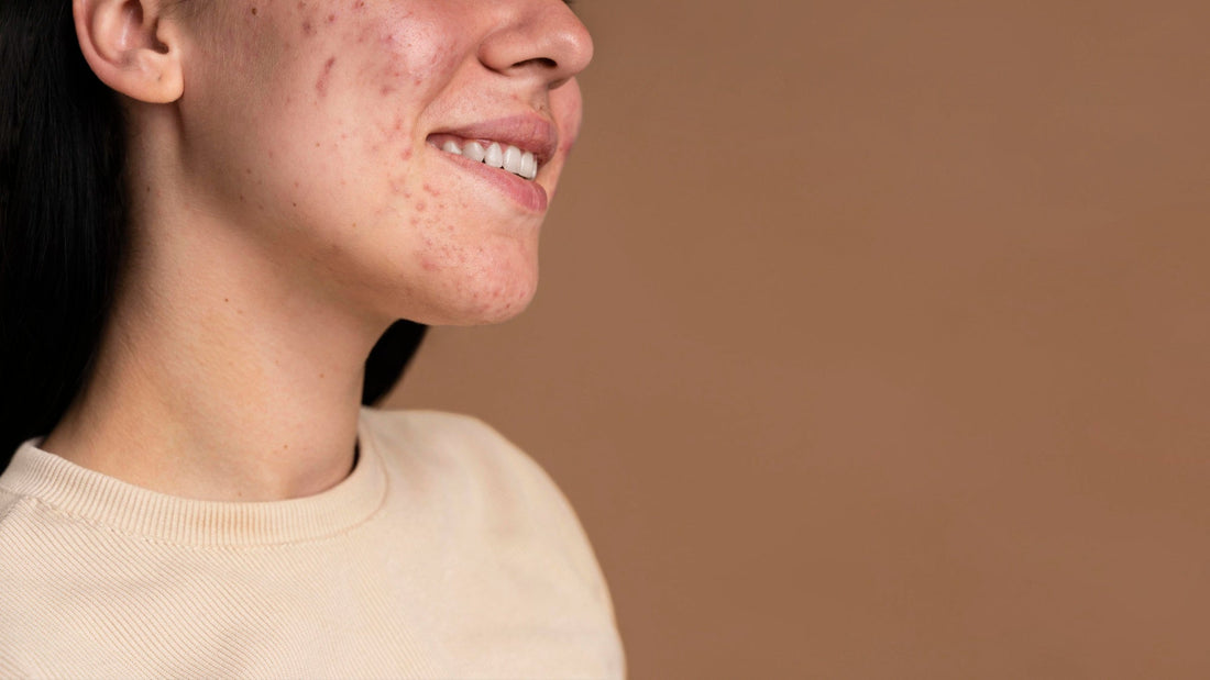 Acne and Stress: How They’re Connected  (And What You Can Do About It)
