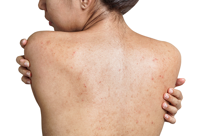 How to Get Rid of Back Acne (Bacne) with the Right Body Wash