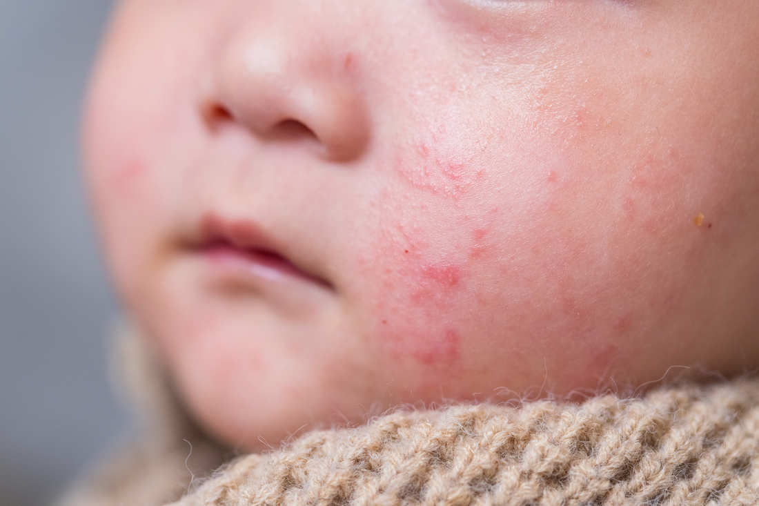 Common Baby Skin Conditions Explained: Eczema, Baby Acne, Cradle Cap, Diaper Rash & Heat Rash