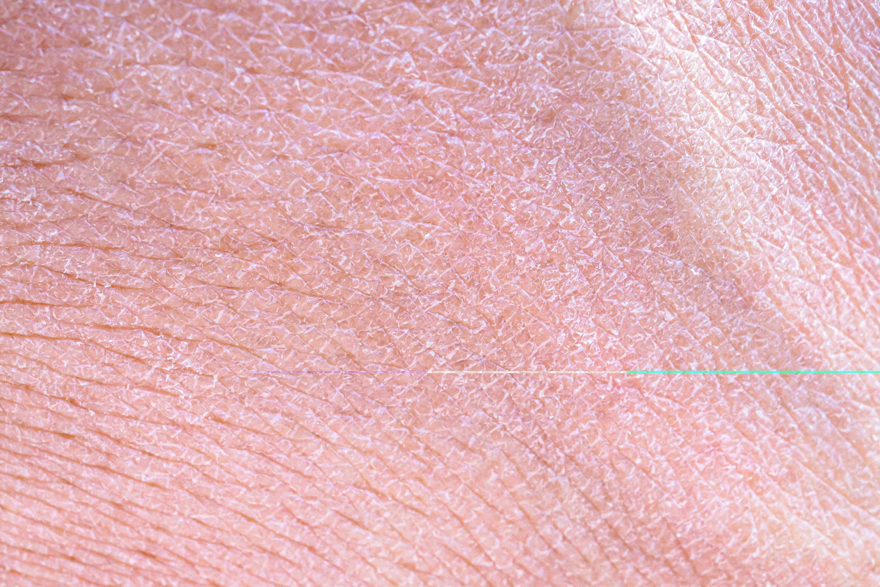 Xerosis (Extremely Dry Skin): Causes, Symptoms & How to Care for It ...