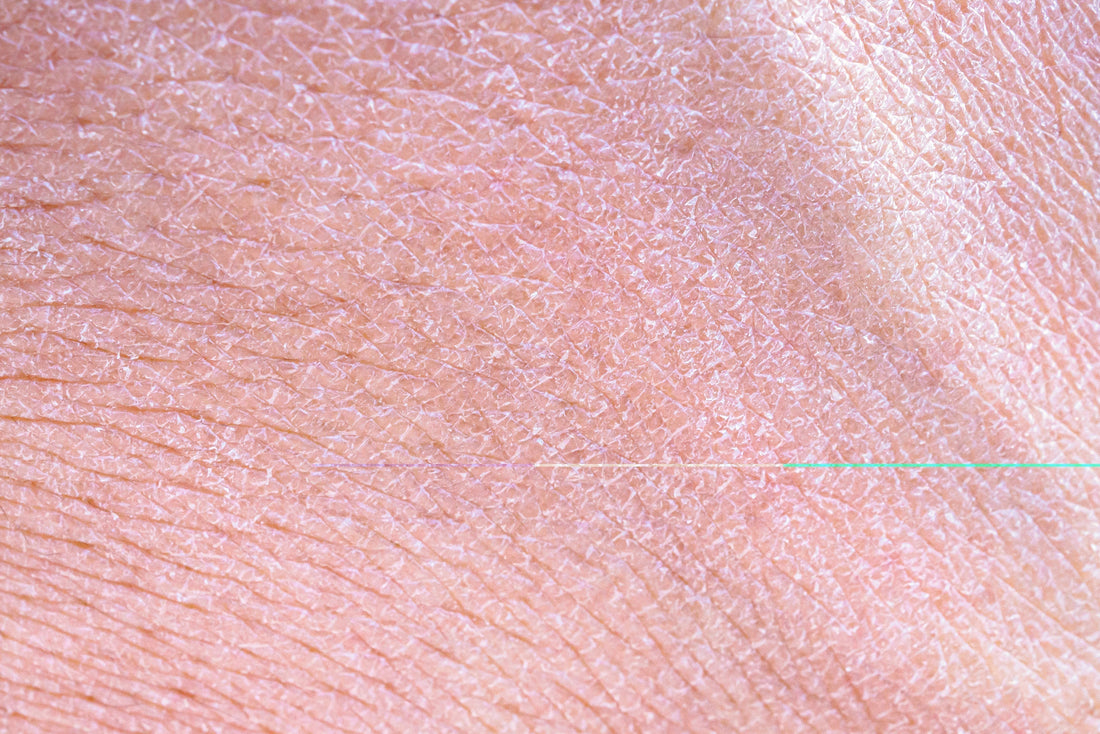 Xerosis (Extremely Dry Skin): Causes, Symptoms & How to Care for It