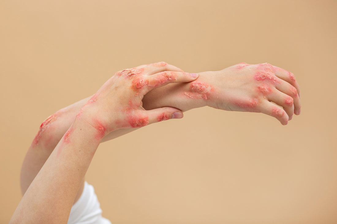 Adult Eczema: What It Is, Why It Happens & How to Care for It