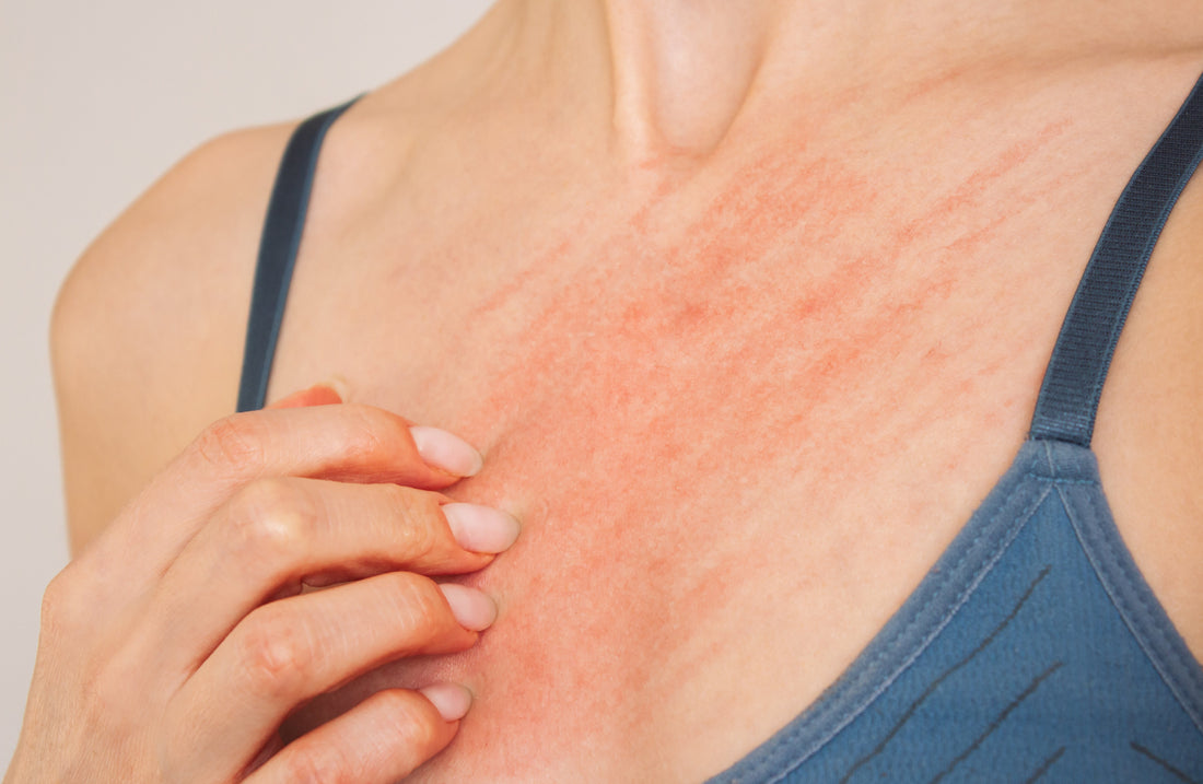 How to Treat and Prevent Heat Rash with Dermally