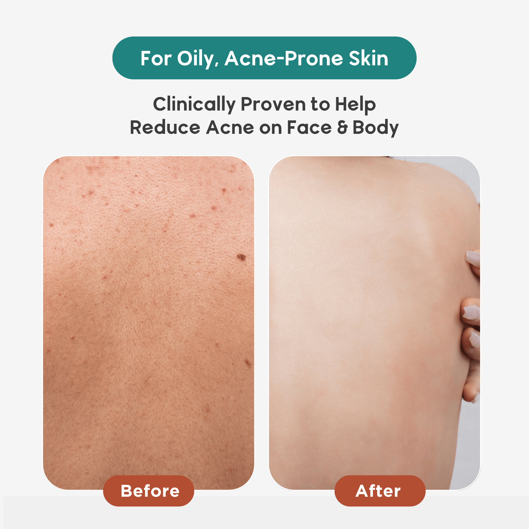 Acne Face & Body Wash